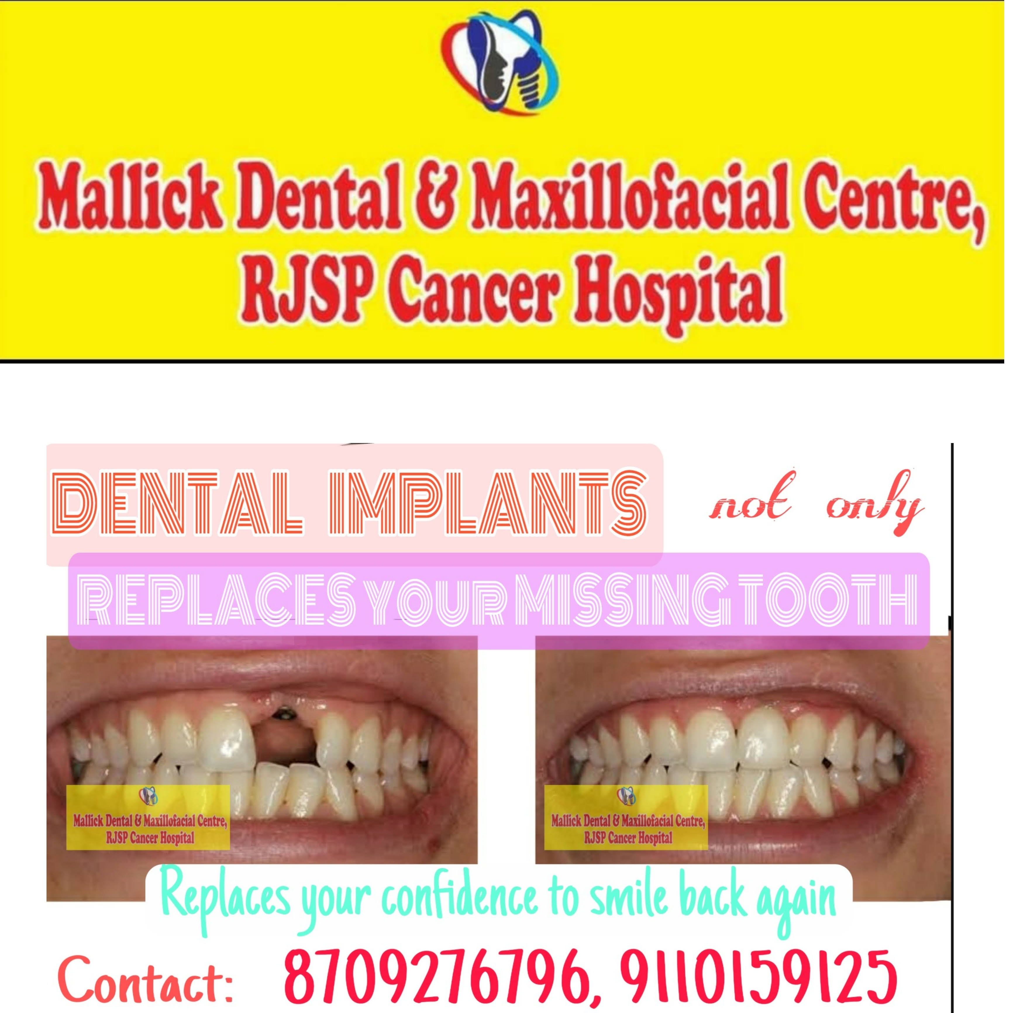 Dental Implant @Mallick Dental clinic & Implant centre product image