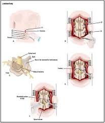 Laminectomy Is Surgery That Creates Space By Removing The Lamina The Back Part Of The Vertebra That Covers Your Spinal Spinal Canal Create Space School Notes
