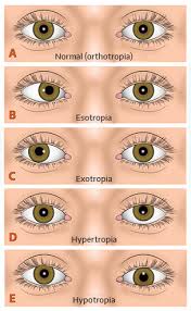 Image result for Strabismus