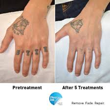 Here are some more reading materials about the process: Sydney Laser Tattoo Removal
