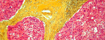 Metastatic breast cancer is breast cancer that has spread to other organ(s) like the lung, liver, bone, brain etc. Metastatic Breast Cancer Diagnosis And Treatment Ucsf Health