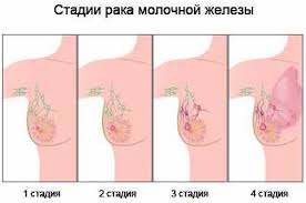 Rak Molochnoj Zhelezy Unim Gistologiya I Immunogistohimiya
