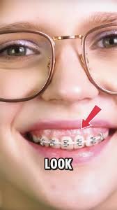 Wie Kann Man Fake Zahnspange Machen Zu Hause