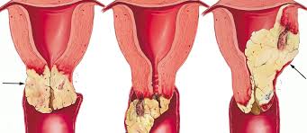 Why Might Vegetarians Have Less Hpv Nutritionfacts Org