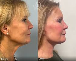 Best Deep Plane Facelift Surgeons UK , London & surrounding