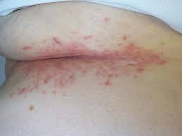 Intertrigo refers to a type of inflammatory rash (dermatitis) of the superficial skin that occurs within a person's body folds. Intertrigo Deximed