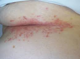 But primarily each cause leads to accumulation of moisture in skin folds. Intertrigo Deximed