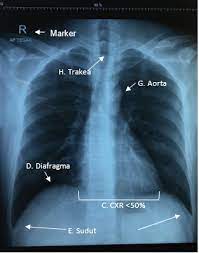 Trauma thorax adalah semua ruda paksa pada thorax dan dinding thorax, baik trauma atau ruda paksa tajam atau tumpul. Interpretasi Rontgen Toraks Alomedika