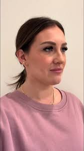 With minimal bruising and instant results that have gotten better by the  day, Randi Bates is thrilled with her newly chiseled chin and seamless  recovery process. “I had a great experience with