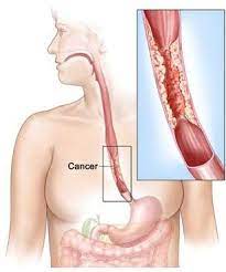 tipos de cancer 10 mortais e porque eles nao tem cura