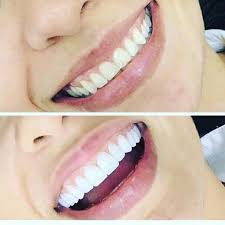 Haw To Whiten Your Teeth At Home Cosmetic Dentistry Dental Student Dentistry
