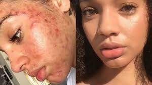 May 10, 2021 · frequently asked questions on fungal acne 1. You Could Have Fungal Acne Here S How To Treat It Plat4om