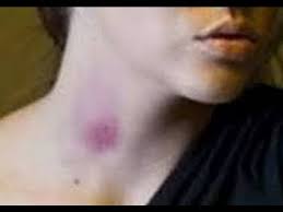 Watch popular content from the following creators: 5 Cara Cepat Hilangkan Cupang Di Leher Youtube