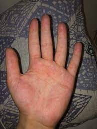 Komische Blaschen Auf Der Hand Gesundheit Und Medizin Gesundheit Korper