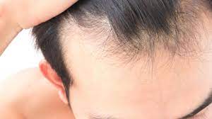 Have a look at these twins from one who does smoke, and one who doesn't. From Smoking To Stress And Your Diet Why Your Hair Is Thinning And How To Stop Bald Patches