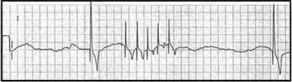 Emergency Arrhythmias Bsava2008 Vin