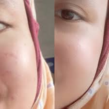 Maybe you would like to learn more about one of these? Cindy On Twitter Short Review Tamanu Oil By Falabelle Ini Minggu Ke 3 Aku Pake Bekas Jerawat Yg Merah Langsung Ilang Kaget Sebagus Itu Dan Yg Item Udah Mudar Tp