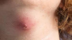Bisul di kemaluan bisa tumbuh di bagian luar kemaluan, sekitar rambut kemaluan, atau pada wanita di bagian bibir vagina. Jangan Dipencet Ini Cara Tepat Tangani Bisul