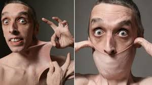 50萬分之1機率！他罹罕病皮膚Q彈破紀錄「脖子皮當口罩戴」