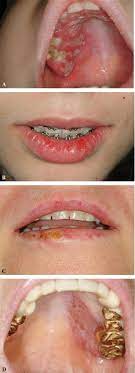 Examples Of Clinical Manifestation Of Herpes Simplex Virus Type 1 Download Scientific Diagram