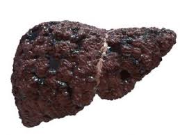 Image result for fatty liver