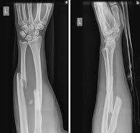 Radius and Ulnar Shaft Fractures - Trauma - Orthobullets