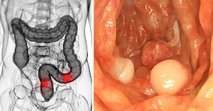 Routine screening can help your health care provider find cancers earlier, when they are easier to treat. 5 Simple Habits That Significantly Lower Your Risk Of Colon Cancer David Avocado Wolfe