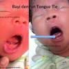 Lidah bayi putih karena jamur. 1
