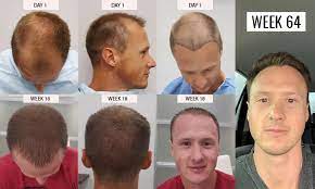 The cost of a hair transplant in the uk at a private clinic is estimated to be anywhere between £1,000 and £30,000, but is usually between £3,000 and £7,000. Hair Transplant In Mexico Tijuana Fue 3 800 Bbb Certified