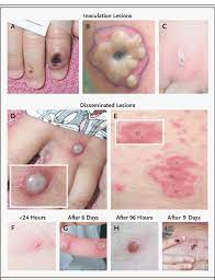 This is followed by a rash that forms blisters and crusts over. Primary Inoculation Reactions Panels A B And C Examples Of The Download Scientific Diagram