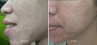 • protone pump inhibitors are used for. Zap Premiere Clinic
