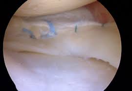 Even a complete ligament tear can heal without surgical repair if it is immobilized appropriately. Can A Meniscus Tear Heal Howard J Luks Md