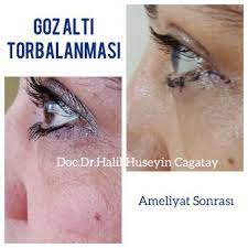 Goz Alti Sismesi Neden Olur Doc Dr Halil Huseyin Cagatay