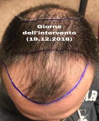 If you need to find your local post office, it's easier than ever before. I Trapianto Capelli Fue Istanbul Fix Hair Istanbul Facebook