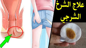 علاج فعال للشق الشرجي في غضون ايام قليلة سيختفي الشرخ الشرجي للأبد Youtube