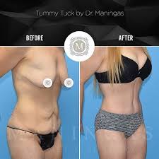 Pin On Abdominoplasty Or Tummy Tuck