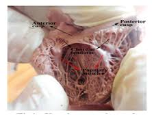 Developments in clinical practice in the last 25 years and Morphology And Morphometry Of Bicuspid Valve In Human Fetal Cadavers Medcrave Online