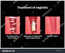 Image result for Vaginitis