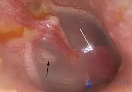 Image result for Glomus tumor