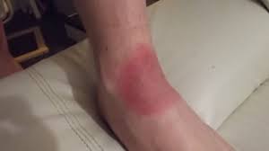 Clinique de la borreliose de lyme la borréliose de lyme est une maladie liée à une bactérie du genre borrelia (borrelia burgdorferi sensu lato),transmise par des tiques dures du genre ixodes. Symptomes Des Maladies Vectorielles A Tiques Mvt Media Tiques