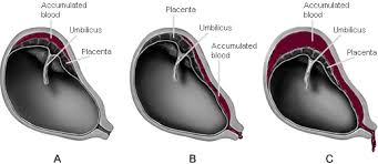 Image result for AmniSure ROM Test