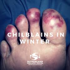 Image result for Chilblains
