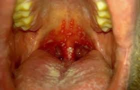 Image result for oral herpes symptoms roof of the mouth
