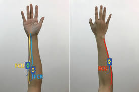 Being an extensor muscle, extensor carpi ulnaris is on the posterior side of the forearm. The Emg Electrodes Placed At The Specific Muscles Including Extensor Download Scientific Diagram