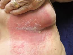 Image result for Candidiasis under breasts