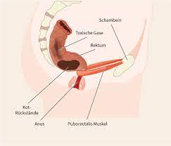 Unter normalen umständen werden die gallenfarbstoffe (das gelbliche bilirubin und das grünliche biliverdin) im darm von den dort. Reizdarm Symptome Ursachen Und Naturliche Behandlung Mithilfe Eines Toilettenhockers