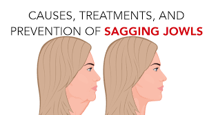 Exercises to lift sagging jowls. Causes Treatments Prevention Of Sagging Jowls Womenworking