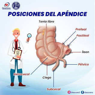 Posiciones Anatómicas Variantes Del Apéndice Cecal: Retrocecal, Pélvico, Subcecal, Preileal Y Postileal, Generada Por Ia