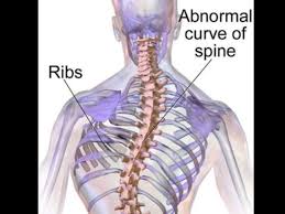 How Might You Know That Your Child Has Scoliosis