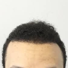 He is very experienced in men's african. African American Hair Transplant Ziering Medical Get Appointment Now